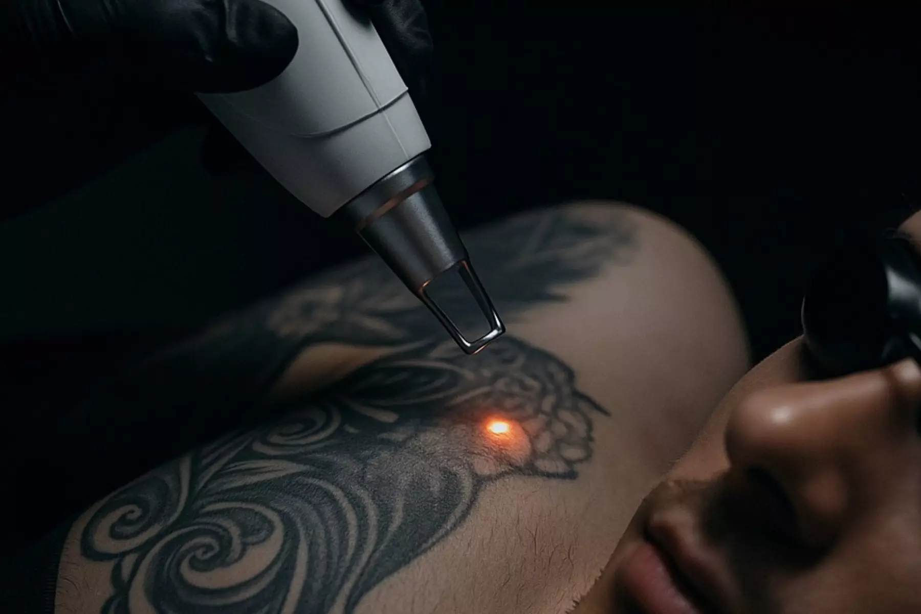 Laser Hair Removal Sessions or Laser Carbon Peel or Acne Treatments
