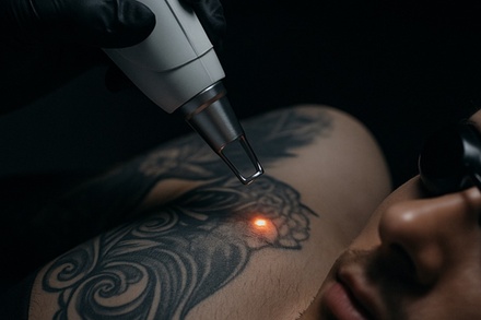 2 Laser Acne Treatments  - ONYX Laser Skin Therapy