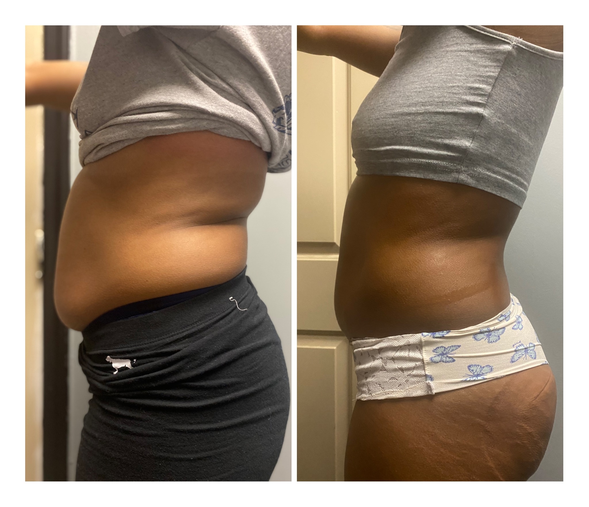 Up to 55% Off on Lipo - Non-Invasive Laser-iLipo 
