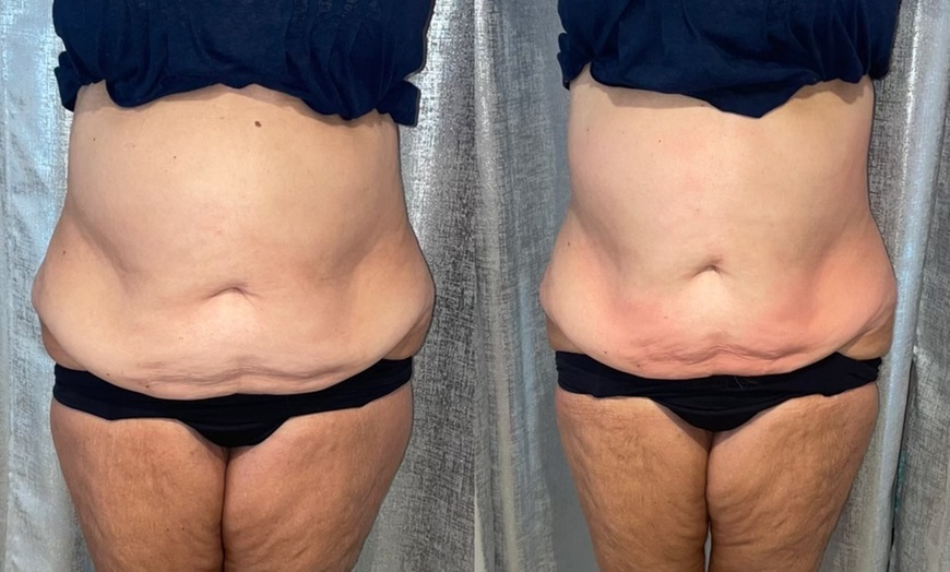 Image 2: Noninvasive ultrasonic cavitation sessions to target stubborn fat