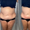 Image 2: Noninvasive ultrasonic cavitation sessions to target stubborn fat