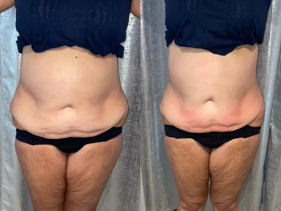 Noninvasive ultrasonic cavitation sessions to target stubborn fat