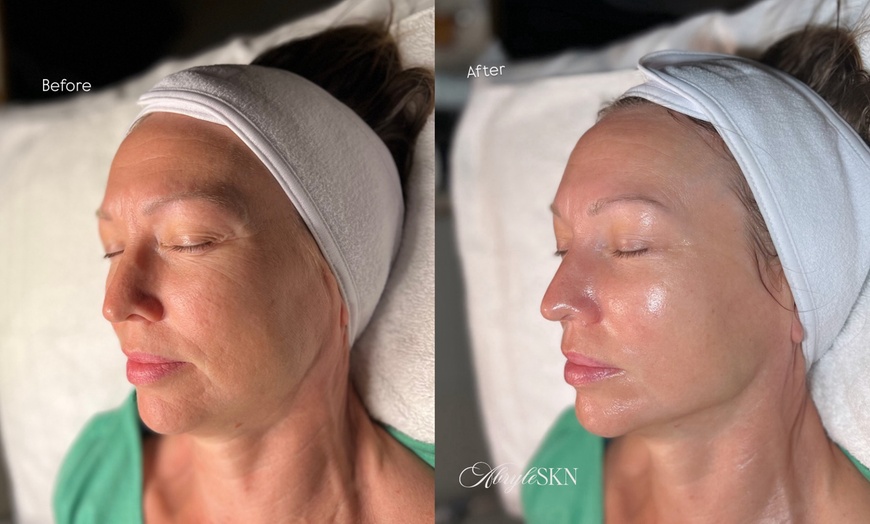 Image 1: Up to 30% Off on Facelift - Non-Surgical at AbryleSKN