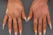 One Syringe of Radiesse for Neck / Décolleté and Hand Rejuvenation at No Pain All Gain Spa (Up to 30% Off) - Second Medium