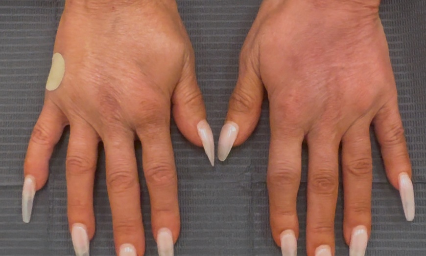Image 2: One Syringe of Radiesse for Neck / Décolleté and Hand Rejuvenation at No Pain All Gain Spa (Up to 30% Off)