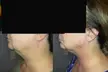 Single Session of BodyFX or MiniFX Fat Reduction and Skin Tightening at Ciao Bella MedSpa (Up to 50% Off) - Second Medium