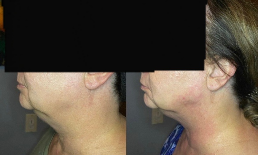 Image 3: Single Session of BodyFX or MiniFX Fat Reduction and Skin Tightening