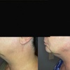 Image 3: Single Session of BodyFX or MiniFX Fat Reduction and Skin Tightening