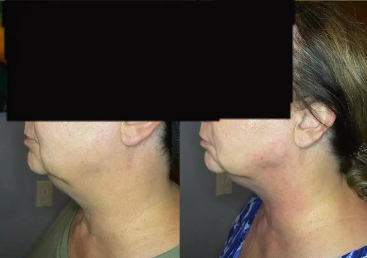 Single Session of BodyFX or MiniFX Fat Reduction and Skin Tightening