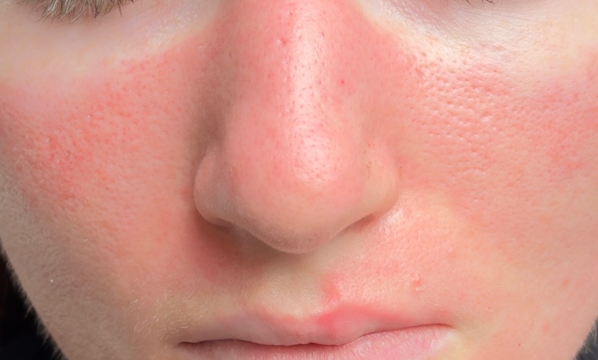 Image 3: Luxury Exosome Mesotherapy with PDRN for Skin Repair & Radiance