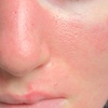 Image 3: Luxury Exosome Mesotherapy with PDRN for Skin Repair & Radiance