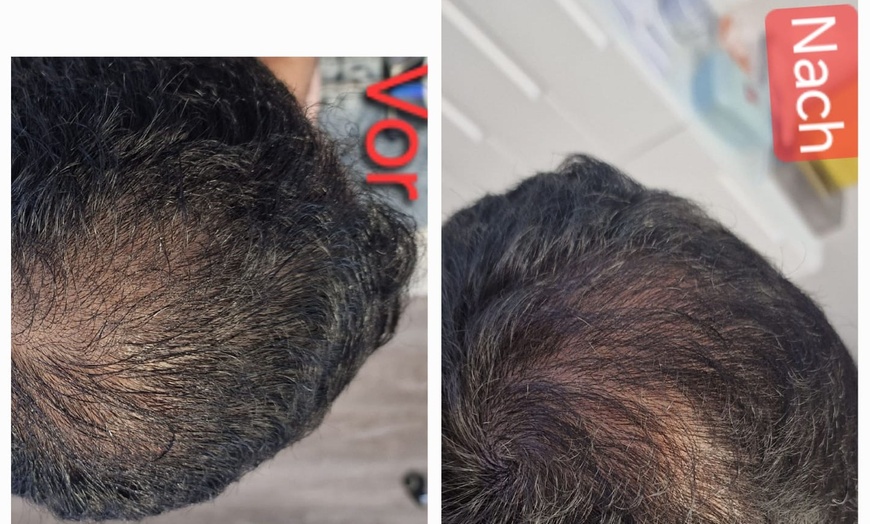 Image 4: Bis zu 10% Rabatt auf den Facial - Eigenblut bei PRIVATPRAXIS Nataliya Katsarova