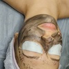 Image 1: Laserowy peeling węglowy twarzy z opcjonalną ampułką i maską algową