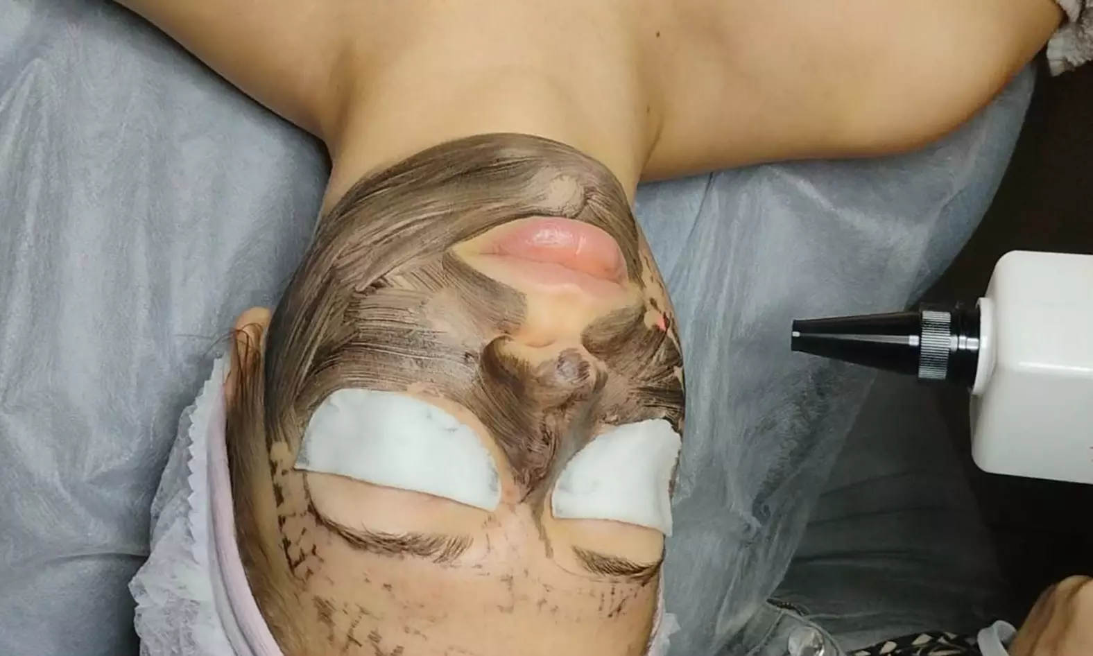 Laserowy peeling węglowy twarzy z opcjonalną ampułką i maską algową w Gabinecie Ingeniumm Termy Maltańskie - Primary Image