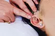 Transform Your Body with Cryotherapy, Acupuncture and More at Tian Chao Herbs & Acupuncture (Up to 45% Off) - Second Medium