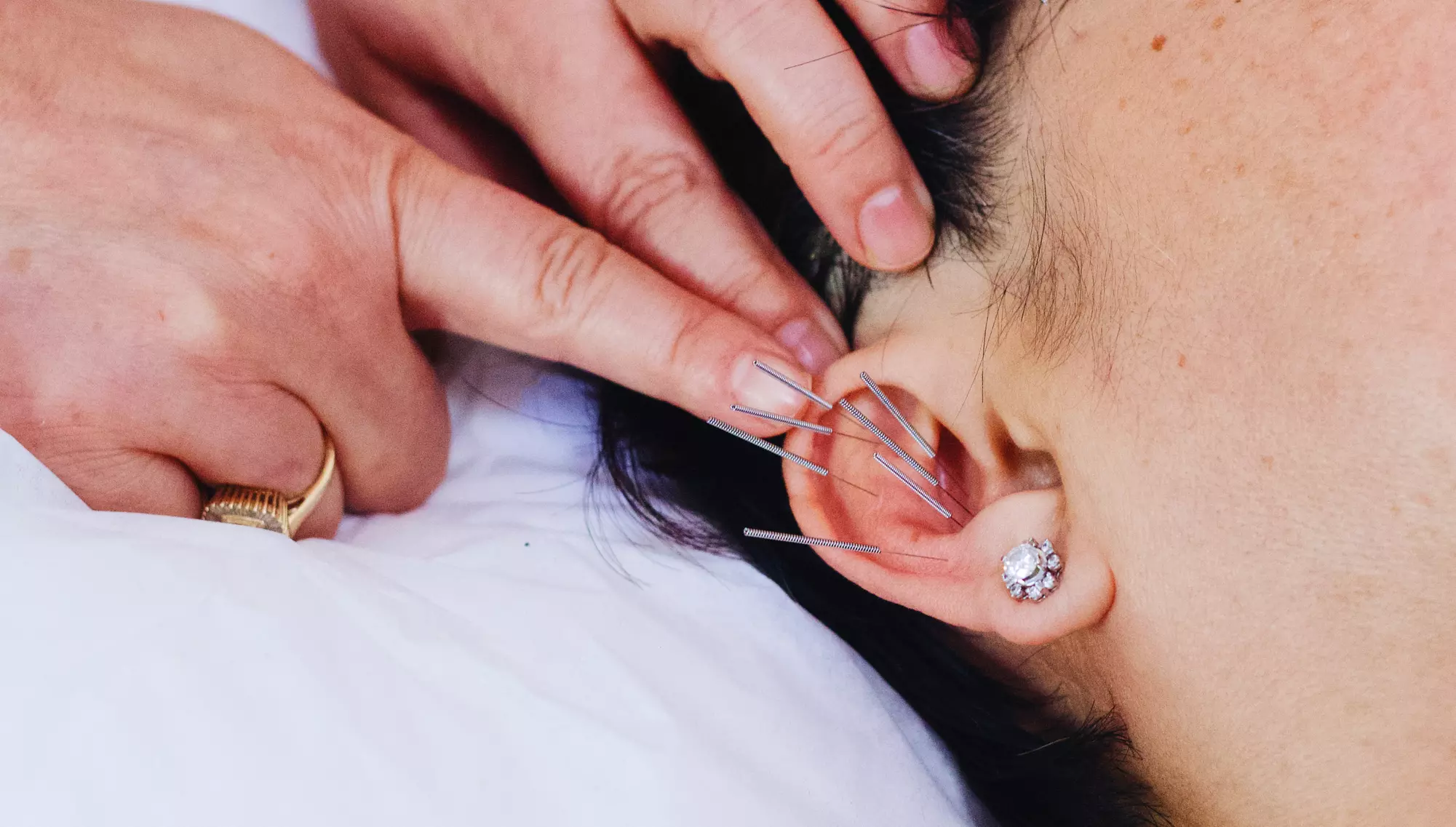 Rejuvenate Your Body: Cryotherapy, Acupuncture and More