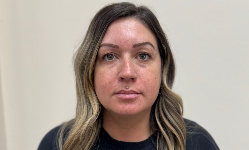 Image 5: Botox 20 - 40 units Lip Filler One Syringe