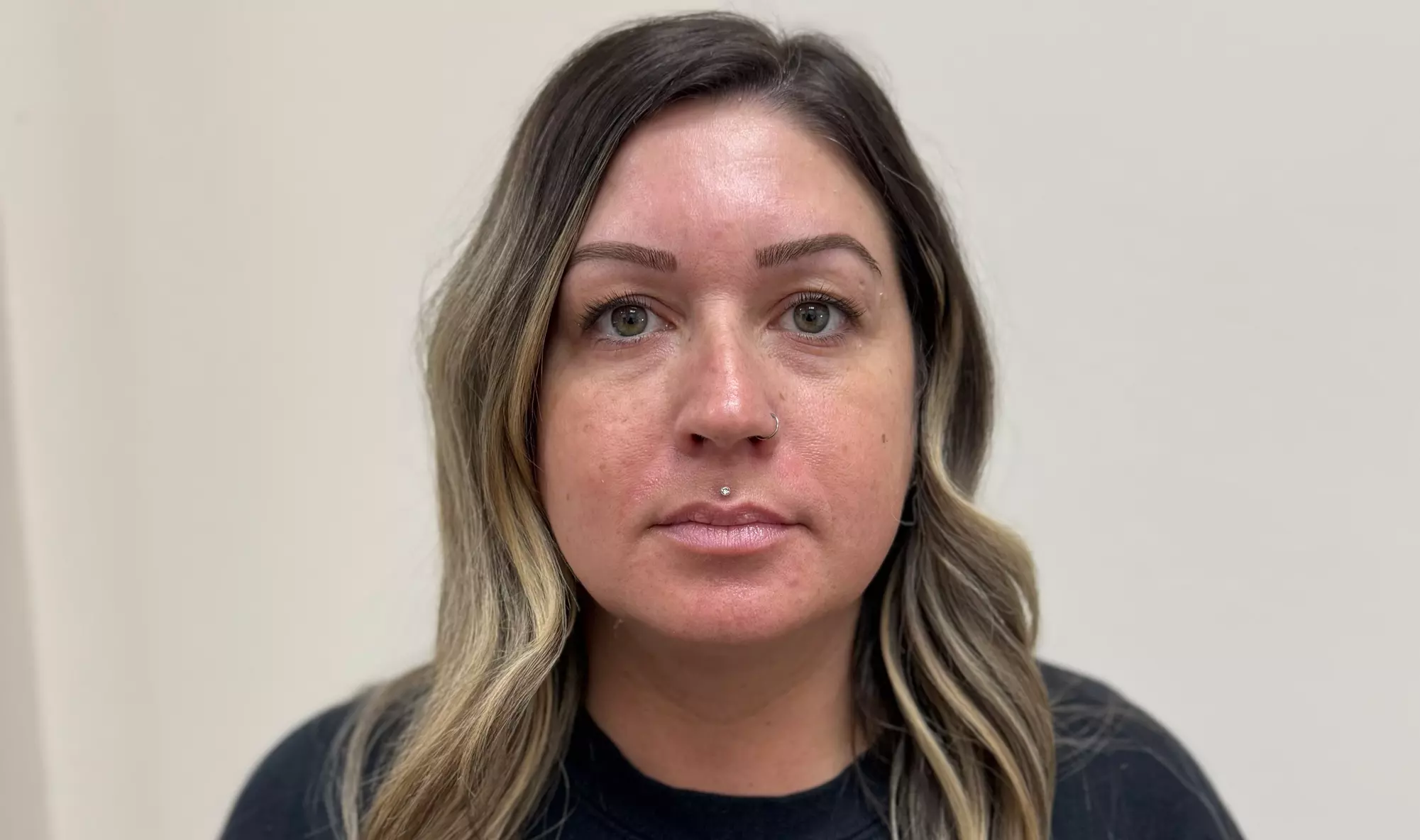 Botox Units (20–40) & Combo/Optional Lip Filler Syringe Injectables