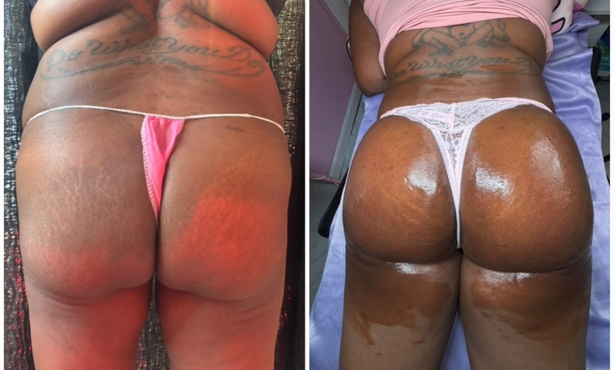 Image 4: Lift and tone with nonsurgical butt cupping sessions