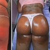 Image 4: Lift and tone with nonsurgical butt cupping sessions