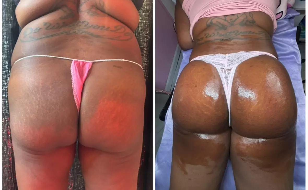 Lift and tone with nonsurgical butt cupping sessions