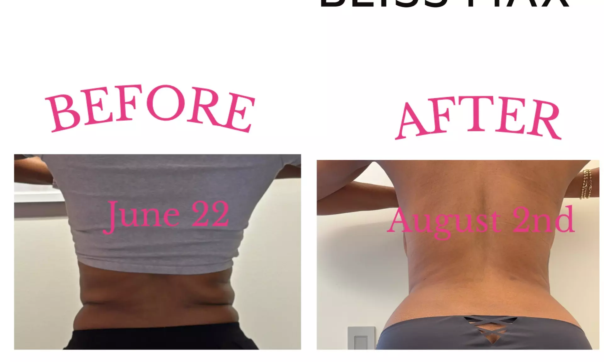 Discover the Power of Venus Bliss:  Laser Lipolysis Treatments at Black Bella Dc Body Sculpting (Up to 40% Off)
