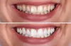 Brighten Your Smile with One or Two Teeth Whitening Treatments at Beauty Doctor NYC (Up To 40% Off)
