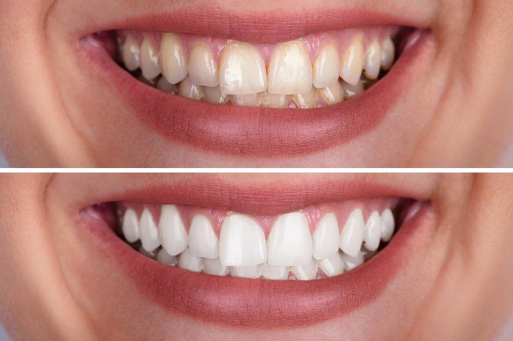Brighten Your Smile with Teeth Whitening Treatments at Lumera Skin Lab