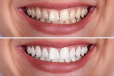 One Teeth Whitening Treatment - Lumera Skin Lab