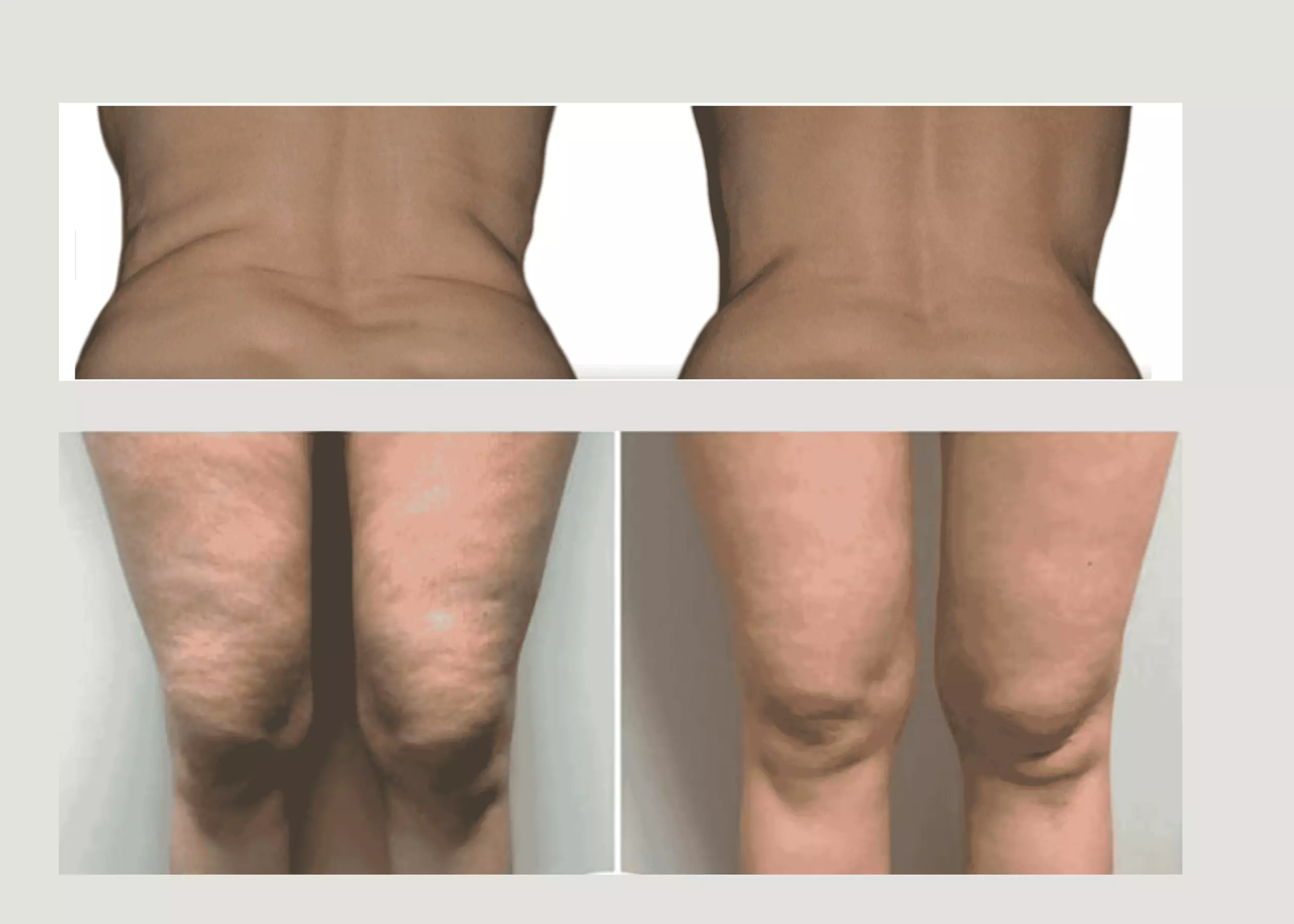 Transform with One or Two Endermologie LPG Cellulite Reduction Treatments at HealthKey MedSpa (Up to 55%Off)