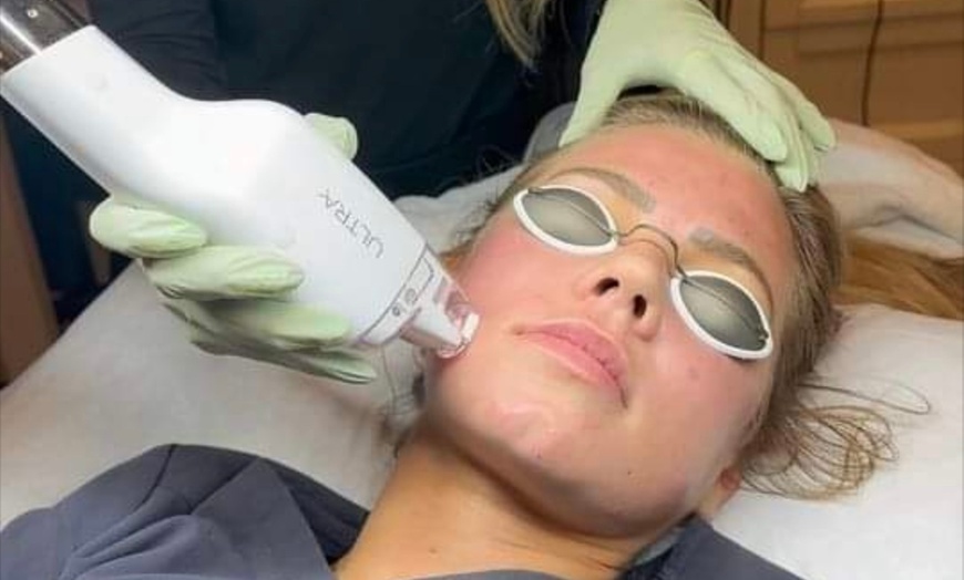 Image 4: Non-Ablative Fractional Laser - LaseMD Ultra for Stretch Marks, Face, Neck, or Hands at Loma Laser (Up to  45% Off)