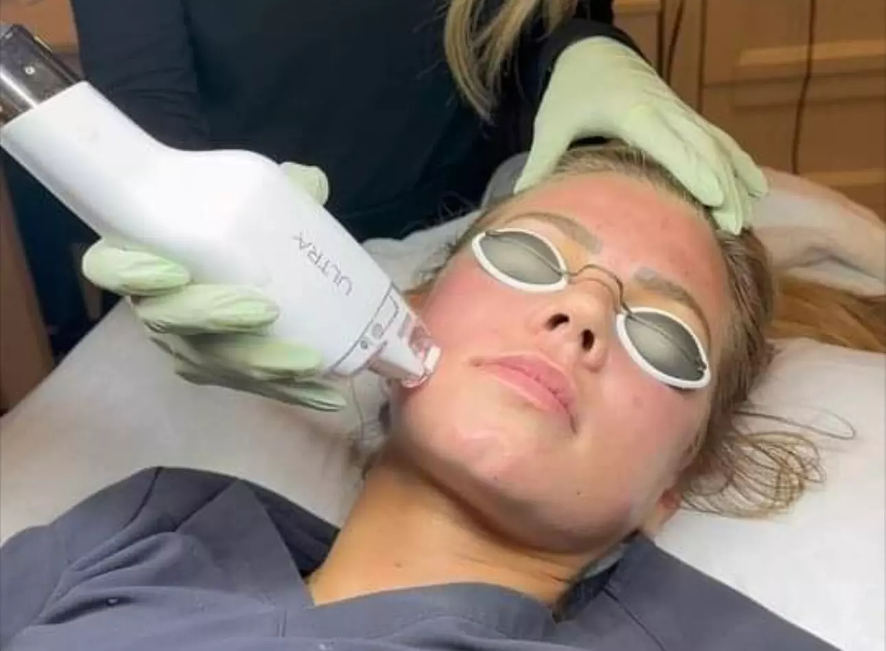 Non-Ablative Fractional Laser - LaseMD Ultra for Stretch Marks, Face, Neck, or Hands at Loma Laser (Up to  45% Off)