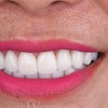 Image 1: Transform Your Smile with a Dental Crown Today