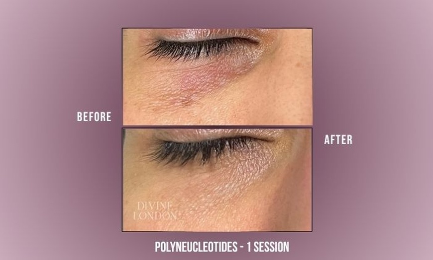 Image 2: Polynucleotides Regenerative Treatment at Divine Aesthetics in London