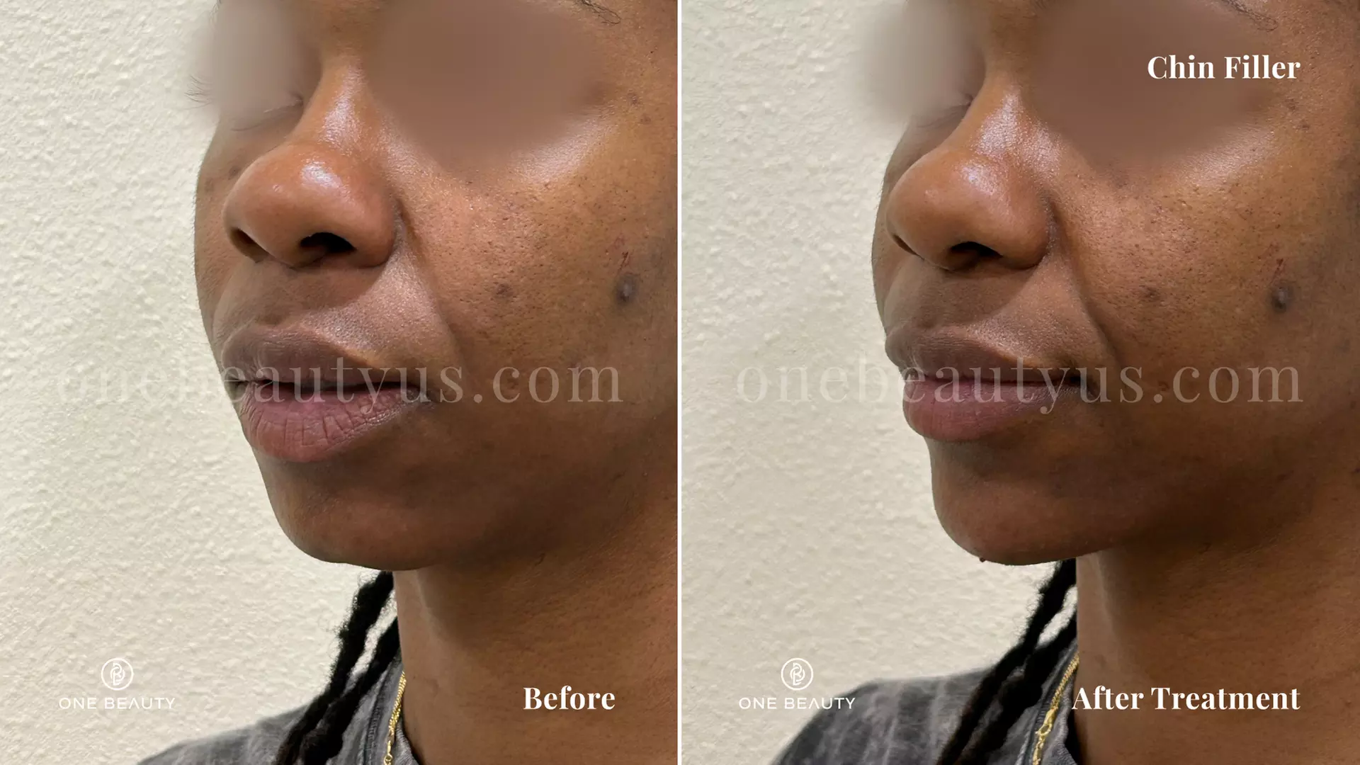 Up to 40% Off on Injection - Restylane at One Beauty Aesthetics - Second Medium