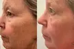 Transform Your Skin with One or Three CO2 Skin-Resurfacing Sessions at Amora Med Spa (Up to 77% Off) - Second Medium