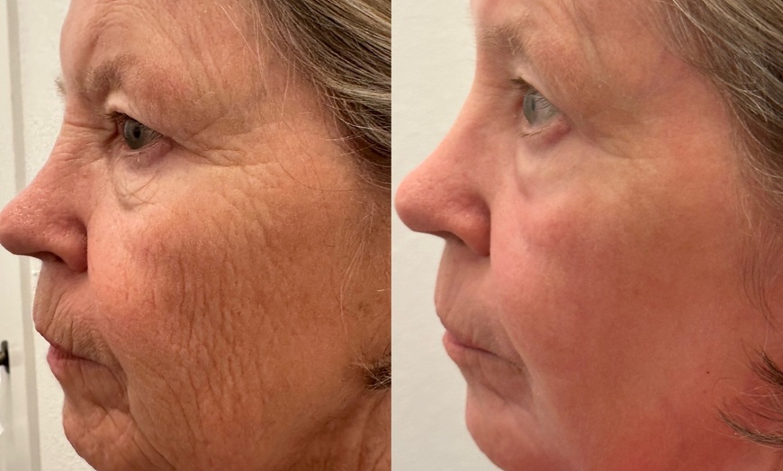 Image 2: Transform Your Skin with One or Three CO2 Skin-Resurfacing Sessions