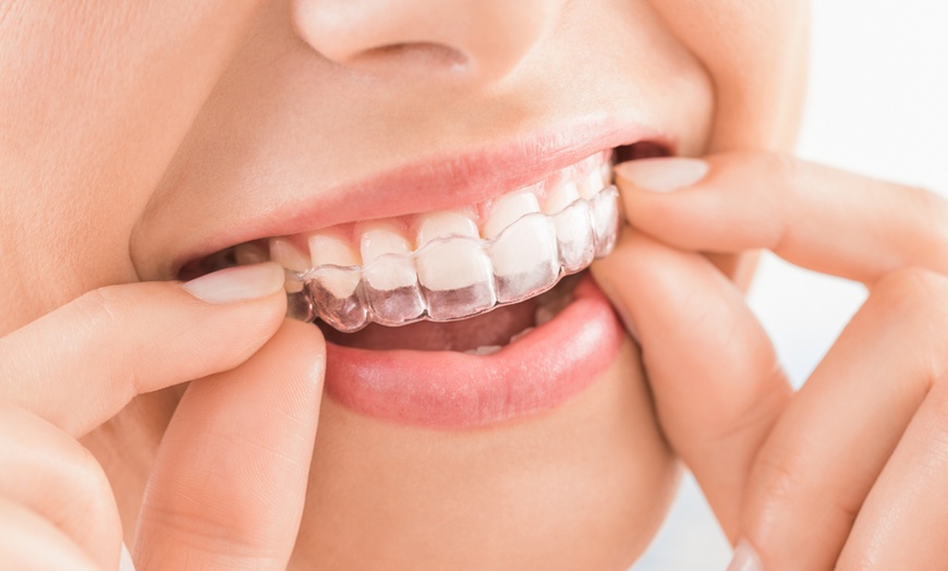 Image 7: Do 50% zniżki na Wybielanie zębów - tradycyjne w Richter Clinic Iwona Richter