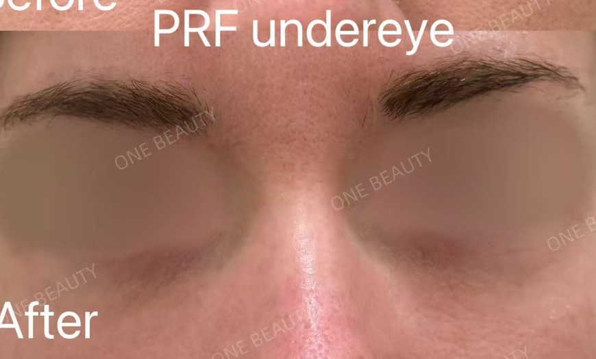 Image 8: Up to 71% Off on Vampire Facelift at One Beauty Aesthetics