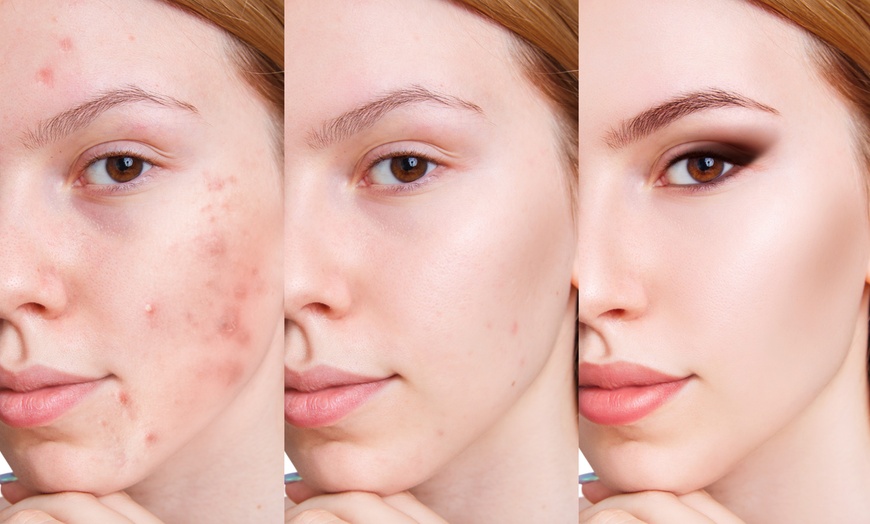 Image 5: Up to 51% Off on Acne Facial at Skin Deep Beauty and Beyond