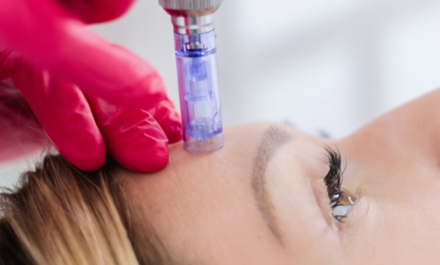 Image 2: Dermaplane (Fresh & Glow) & Microneedling +HA - 1, 2, 3, or 6 Sessions