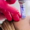 Image 2: Dermaplane (Fresh & Glow) & Microneedling +HA - 1, 2, 3, or 6 Sessions