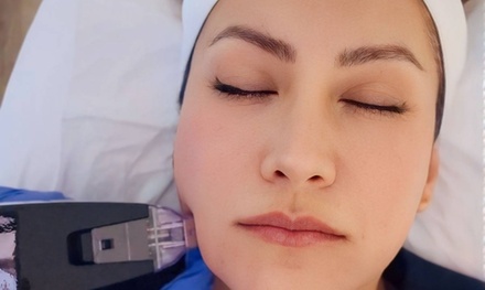 Micro-Needling RF - Golden Youth Face (1 Session) - Atrosa Med Spa
