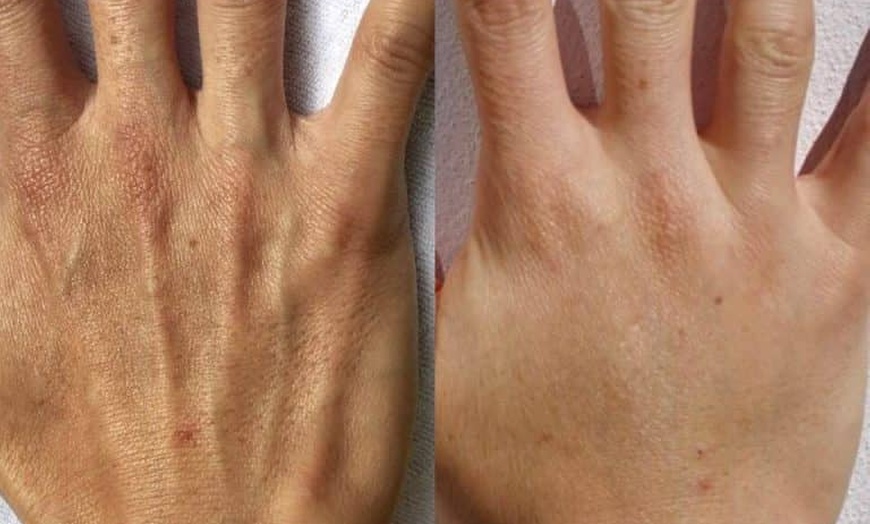 Image 4: Up to 30% Off on Injection - Dermal Filler at No Pain All Gain Spa