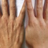 Image 4: Up to 30% Off on Injection - Dermal Filler at No Pain All Gain Spa