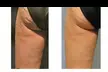 Up to 57% Off on Body-Tite – Non-Invasive Cellulite Reduction & Skin Tightening with Lymphatic Drainage in DC - Second Medium