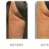 Image 4: Body-Tite – Non-Invasive Cellulite Reduction & Skin Tightening in DC
