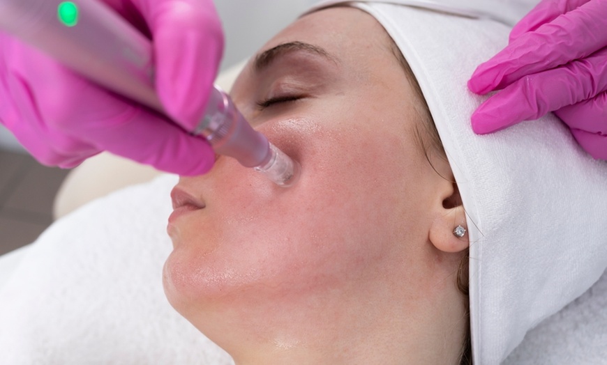 Image 1: Up to 53% Off on Micro-Needling at My Aesthetic Lounge