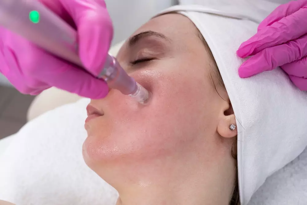 Up to 53% Off on Micro-Needling at My Aesthetic Lounge