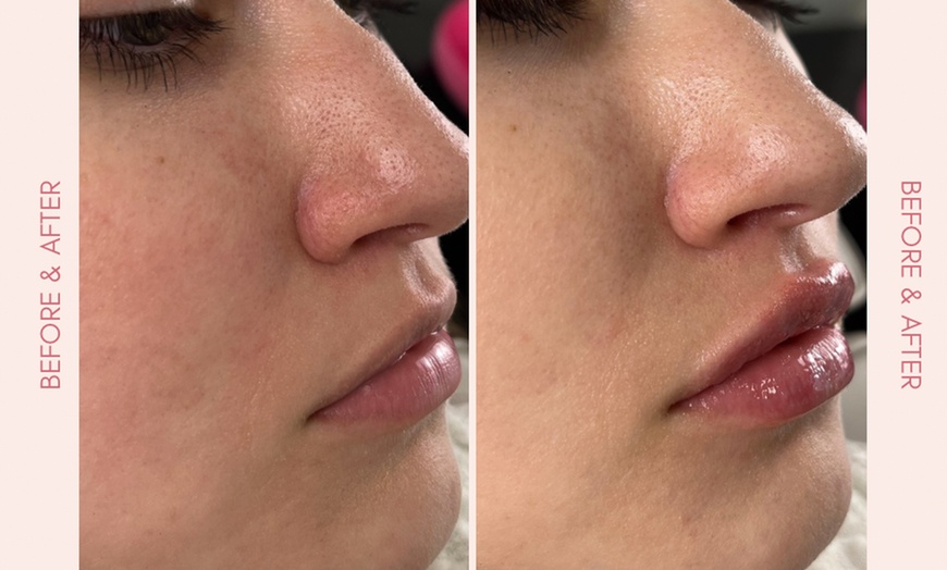 Image 5: Rejuvenate Your Look with 20, 40, or 60 Units of Botox